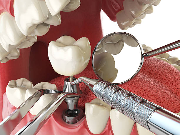 Best Emergency Dental Care for Broken or Chipped Teeth in West Lealman, FL